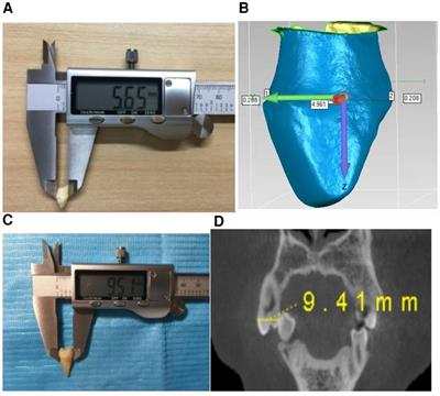 Measurement of the morphological data of primary teeth in northwest China